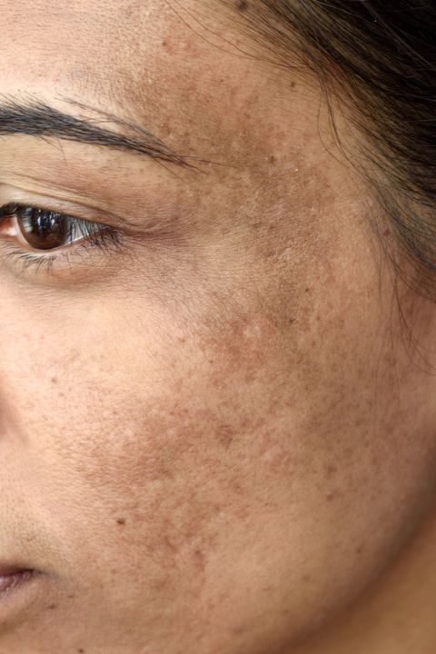 Say Goodbye to Stubborn Spots: How to Fade Hyperpigmentation, Fast!