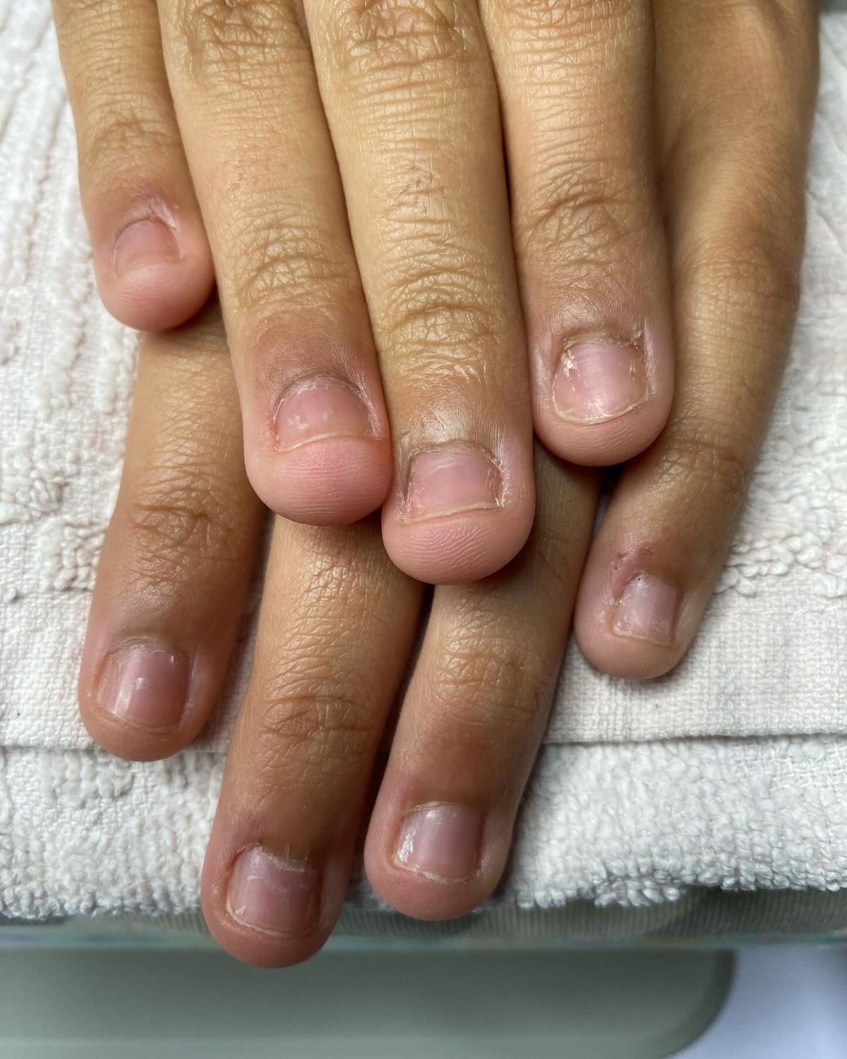 Stop Nail Biting: The Secret to Stronger, Healthier Nails Starts From Within