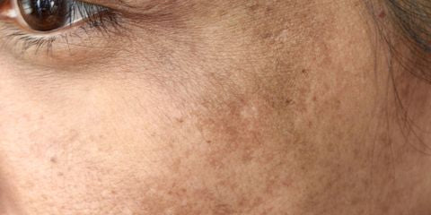 Say Goodbye to Stubborn Spots: How to Fade Hyperpigmentation, Fast!