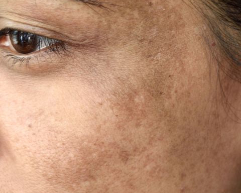 Say Goodbye to Stubborn Spots: How to Fade Hyperpigmentation, Fast!