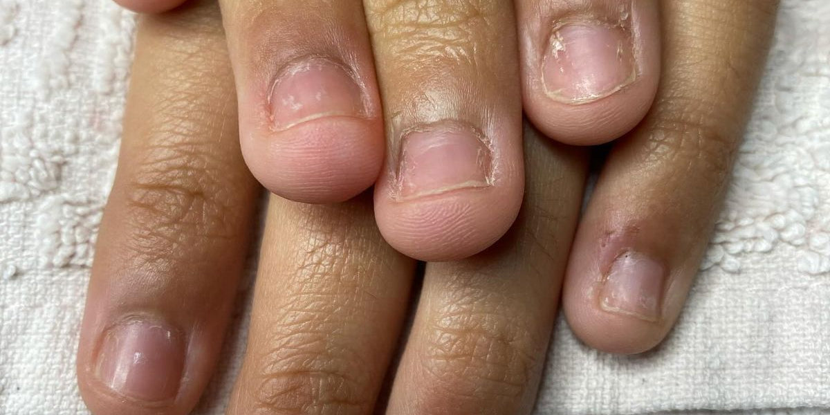 Stop Nail Biting: The Secret to Stronger, Healthier Nails Starts From Within