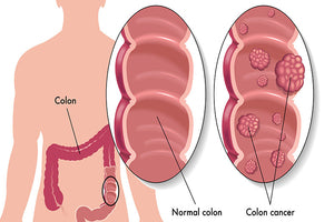 Who Is Most at Risk for Colon Cancer?
