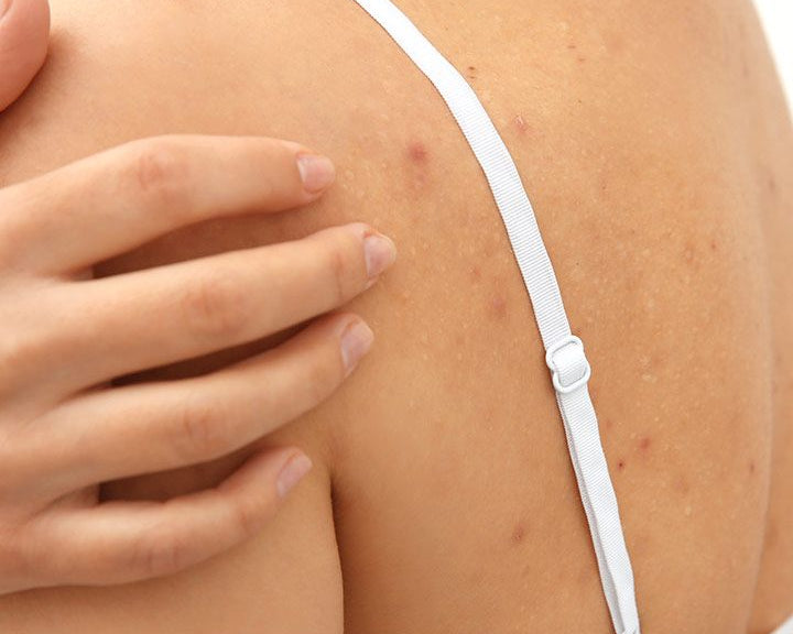 Body Acne That Just Won’t Budge? This Simple Soap Might Be the Game-Changer You Need
