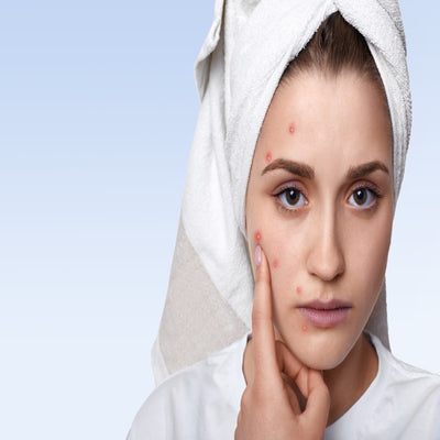 All You Need to Know About Acne in Teens