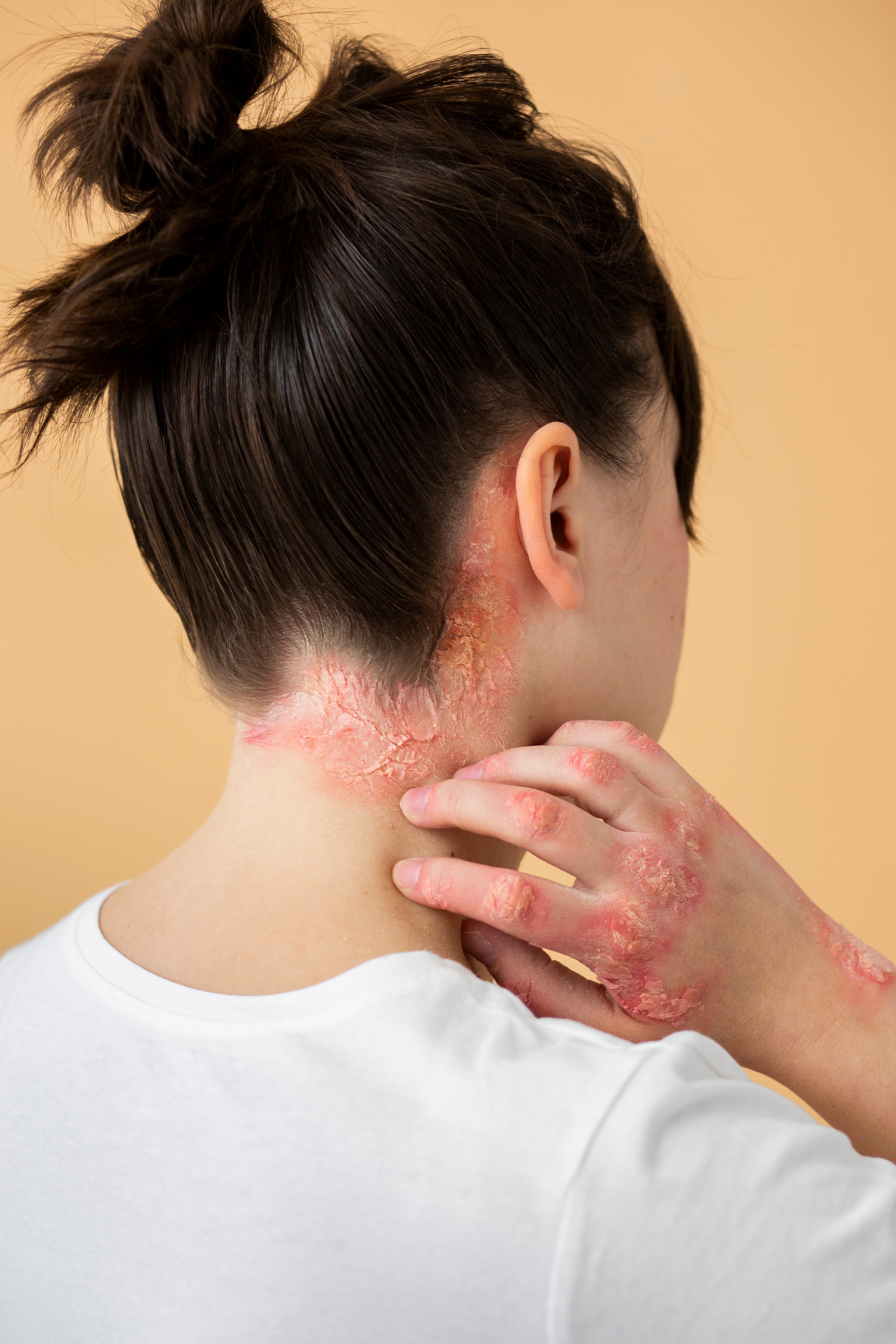 Why Your Skin Is Throwing a Tantrum (Yep, We're Talking About Eczema) - MyLustre.com